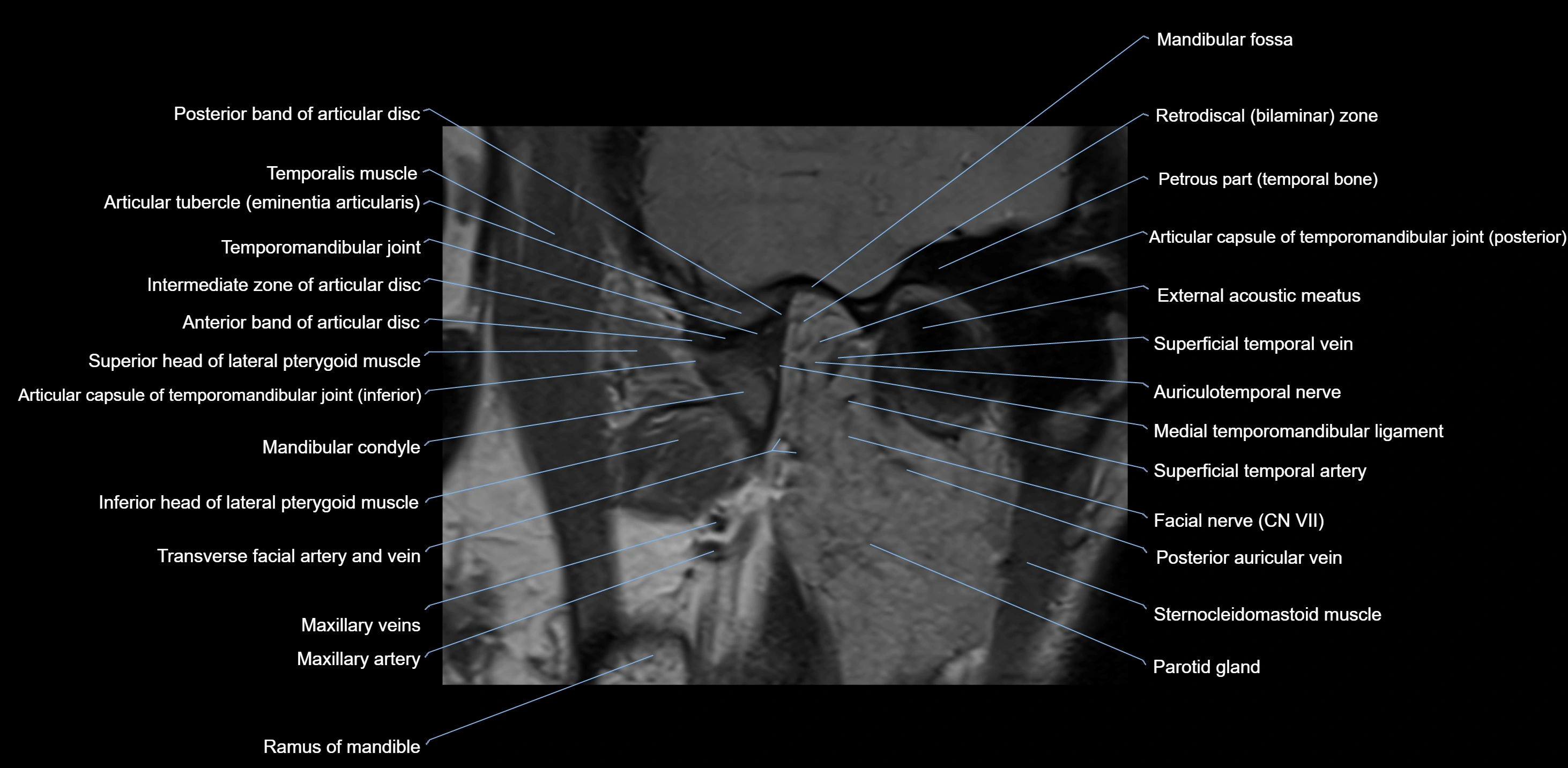 MRI TMJ sagittal open  mouth cross sectional 3T anatomy -img-00001-00008.webp